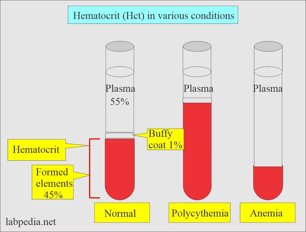 Hematocrit (Hct): Hematocrit (Hct) in various conditions