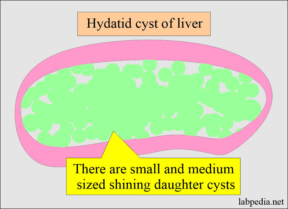 Hydatid cyst liver