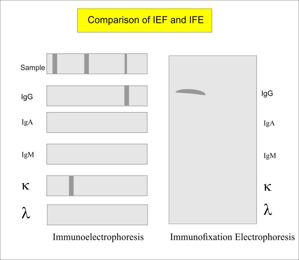 Monoclonal Immunoglobulin (Ig),  Monoclonal antibody,  Immunofixation Electrophoresis (IFE)