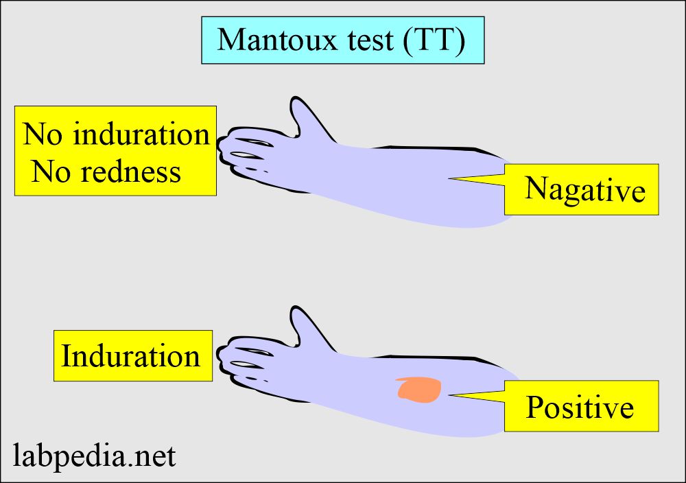 Mycobacterium tuberculosis::  Tuberculin test, Mantoux skin test (T T)