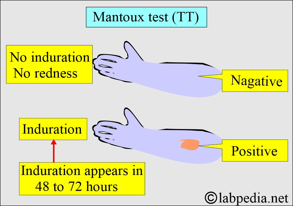 Mantoux Test (TT)
