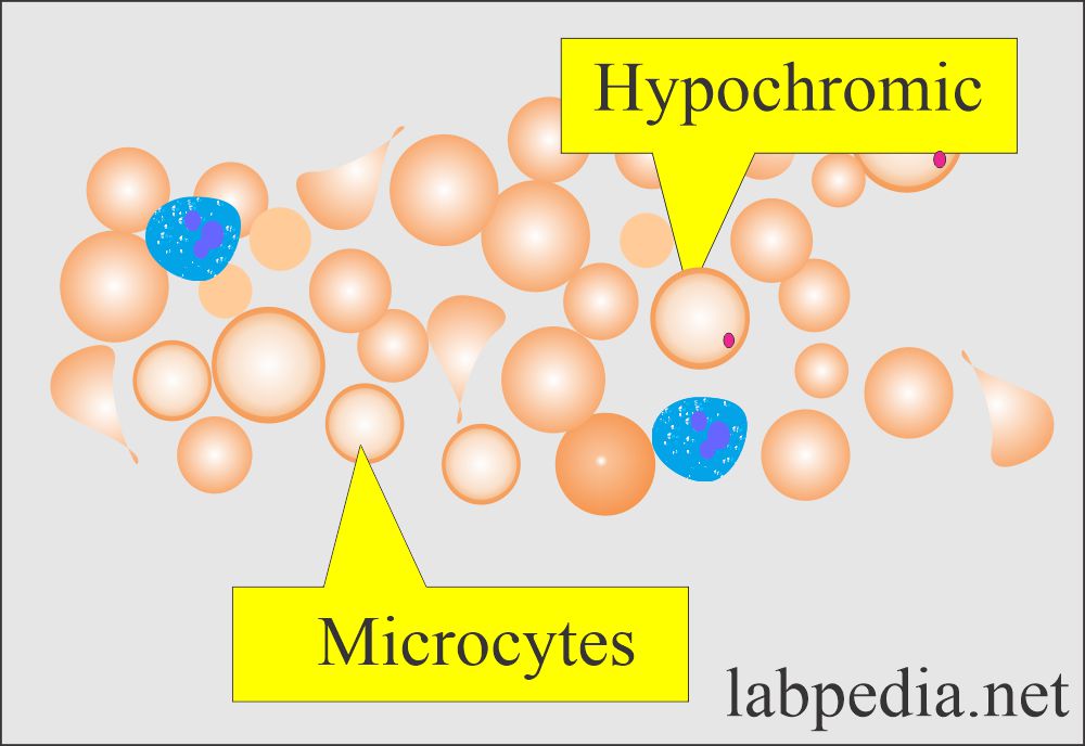 Microcytic hypochromic RBC