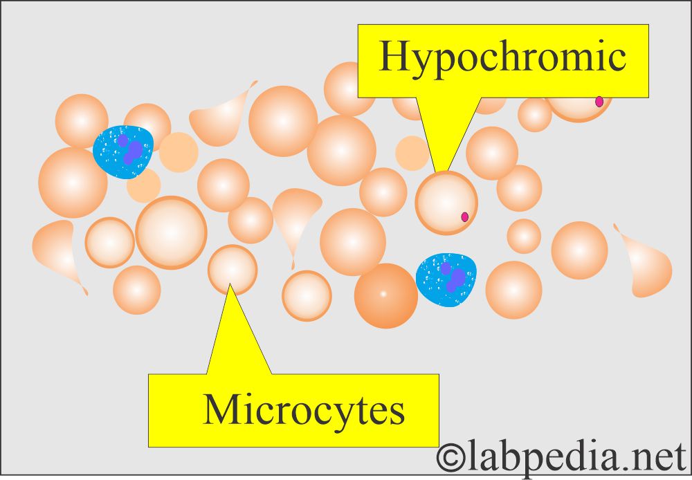 Microcytic hypochromic RBC indicating low MCH Microcytic hypochromic RBC indicating low MCH