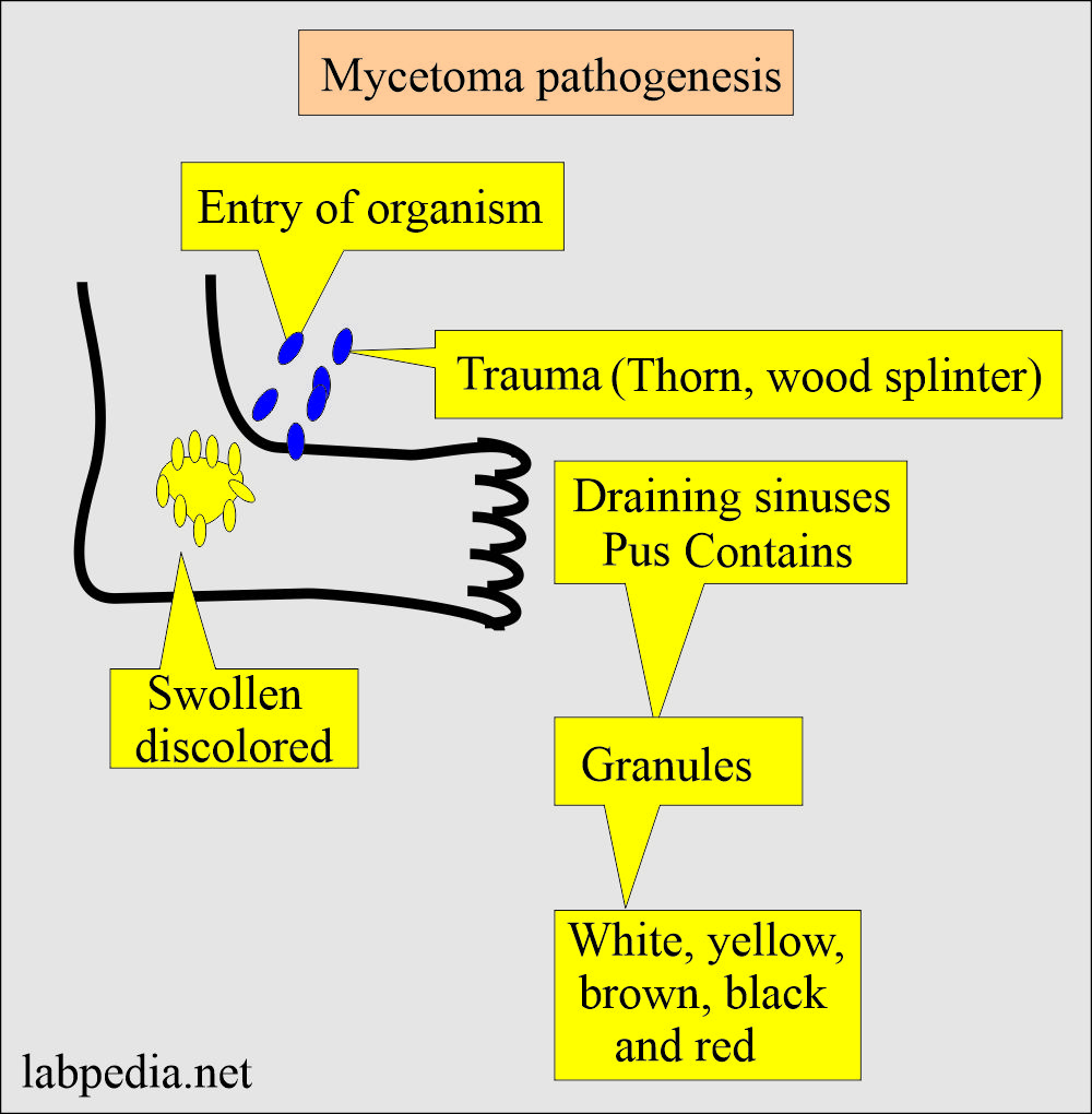 Typical mycetoma