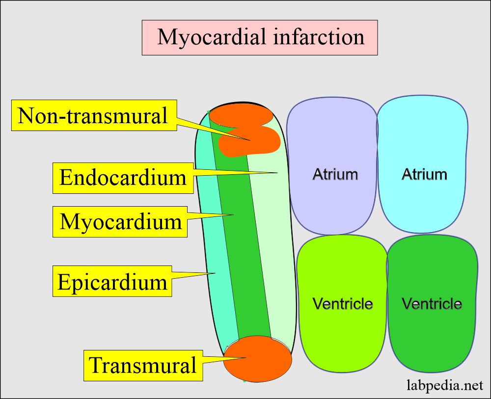 Classification of the myocardial infarction