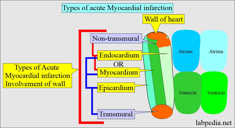 Types of acute myocardial infarction (AMI)
