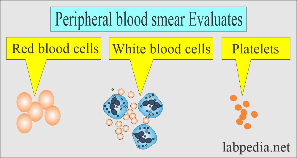 Peripheral blood smear evaluates