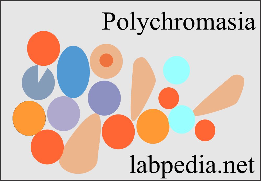 Hemolytic anemia showing polychromasia
