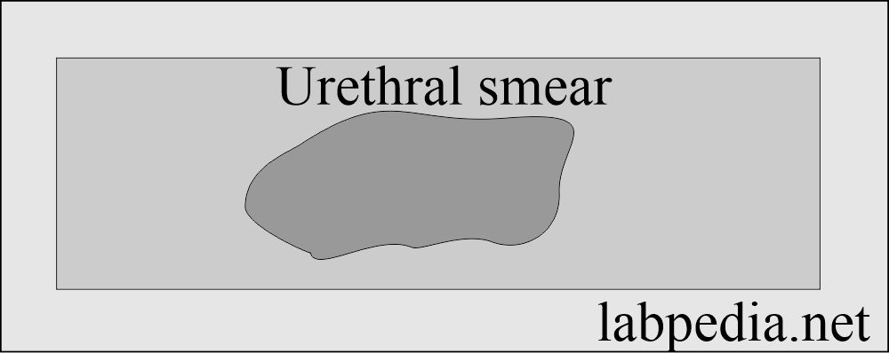 Urethral smear for gonorrhea: Urethral smear for gonorrhea