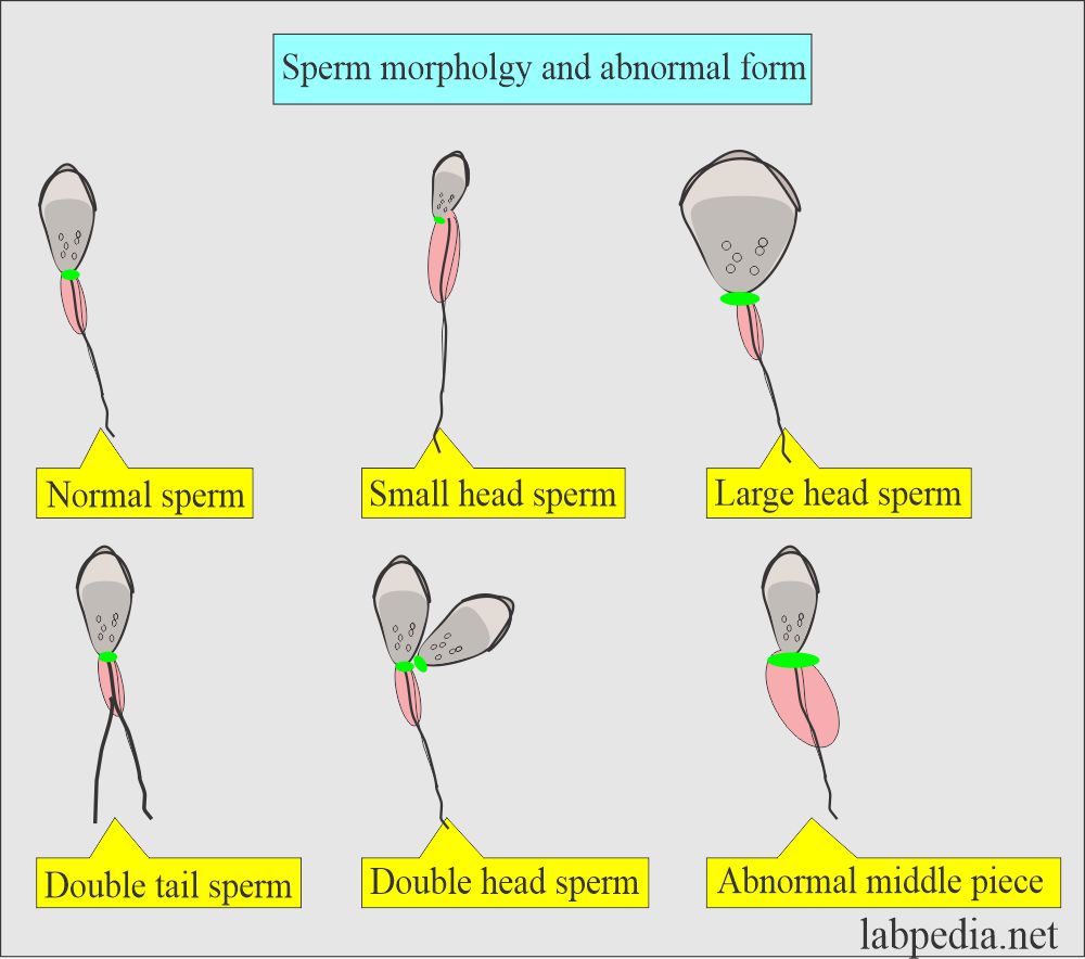 Normal and Abnormal Semen: Abnormal form of spermatocytes