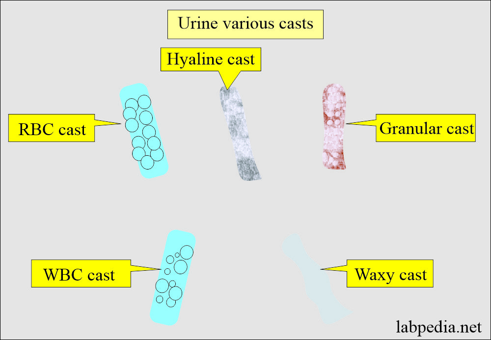 Various types of urinary casts