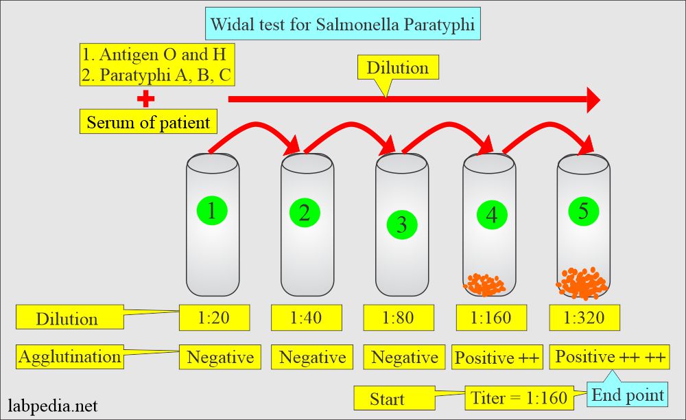 Widal test for Salmonella Paratyphi