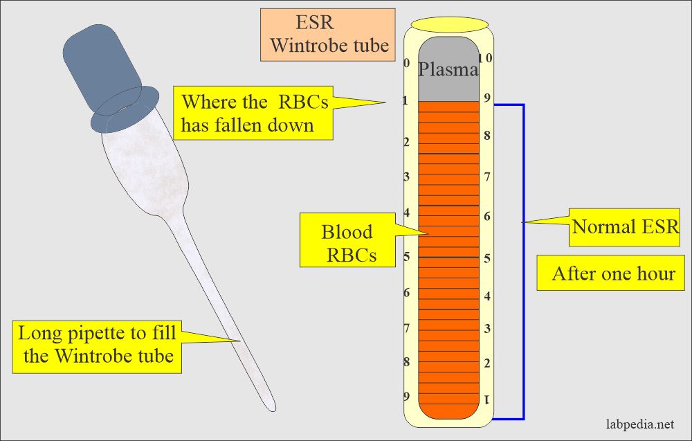Erythrocyte Sedimentation Rate (ESR): ESR by the Wintrobe tube method
