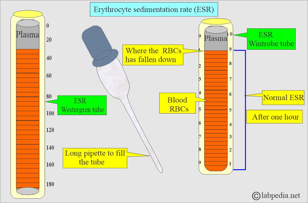 Wintrobe tube and Westergren tube Wintrobe tube and Westergren tube