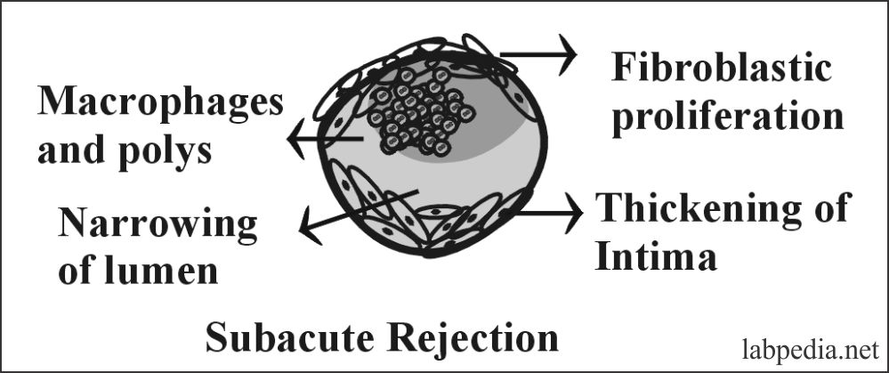 Fig 120: Sub Acute Rejection