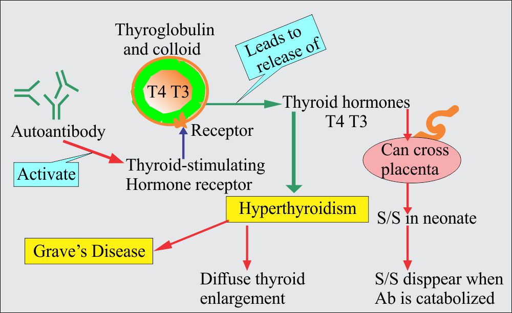 Chapter 23: Autoimmune diseases, Hashimoto’s Thyroiditis and Grave’s disease