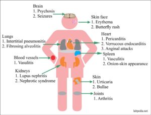 Chapter 17: Autoimmune Diseases:- Systemic Lupus erythematosus (SLE ...