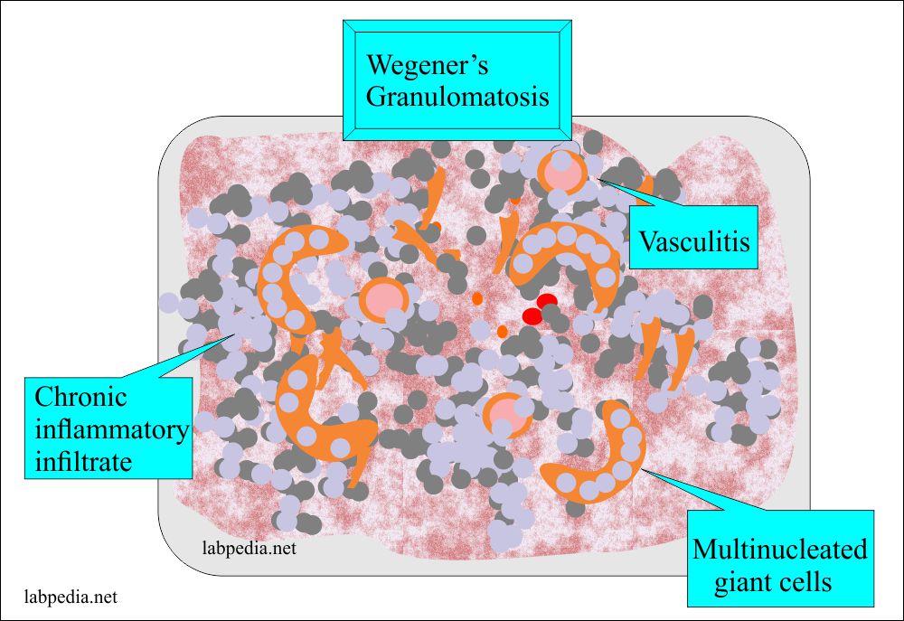 Wegener's Granulomatosis microscopic picture