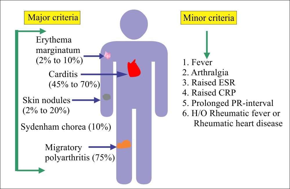 Rheumatic fever diagnostic criteria