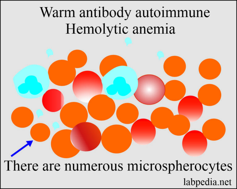 Chapter 27 Autoimmune diseases Autoimmune Hemolytic Anemia (AHA