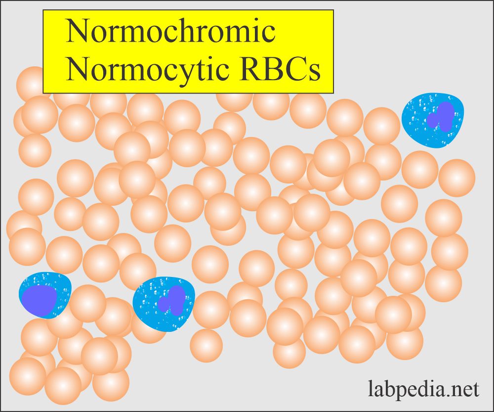 anemia of chronic disease