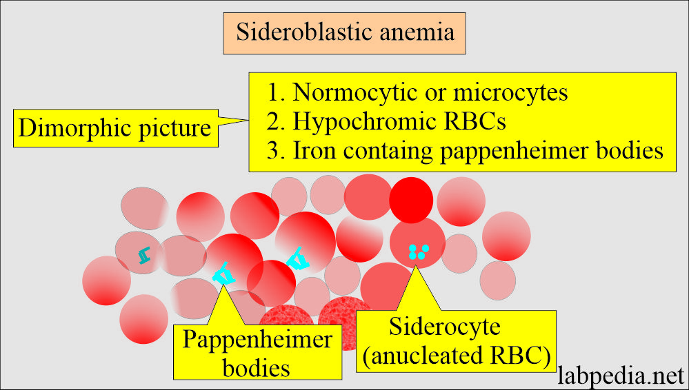 Sideroblastic anemia