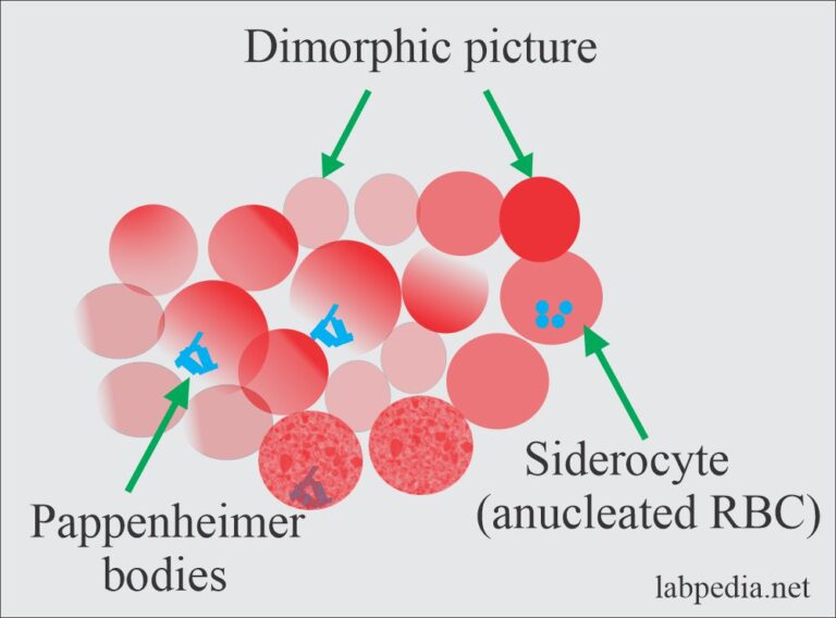 Anemia:- Part 9 - Sideroblastic Anemia, And Anemia Due To Chronic ...