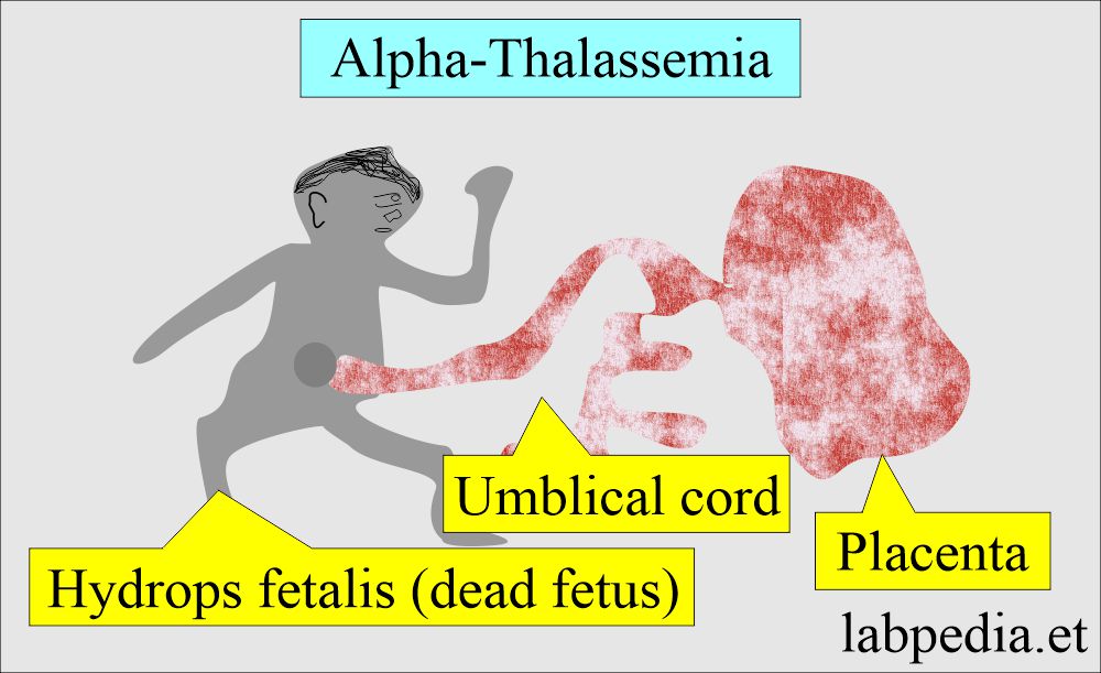 Thalassemia leading hydrops fetalis