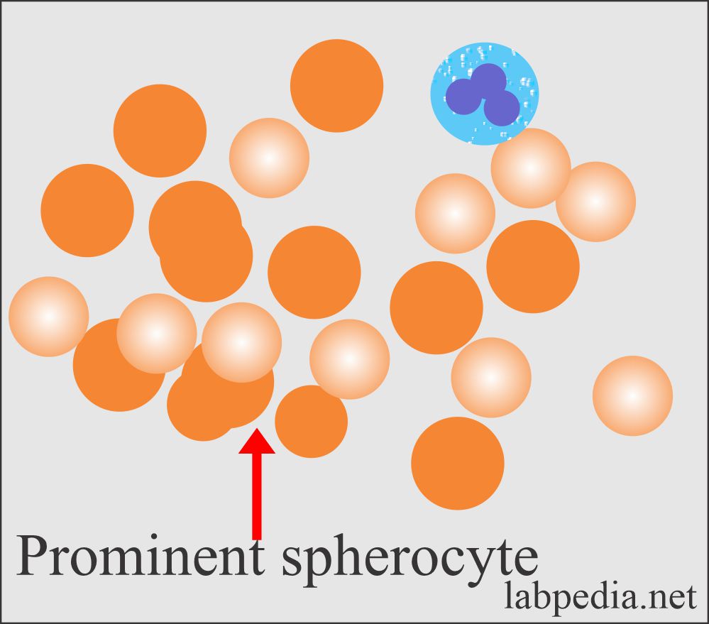 Anemia showing spherocytosis 