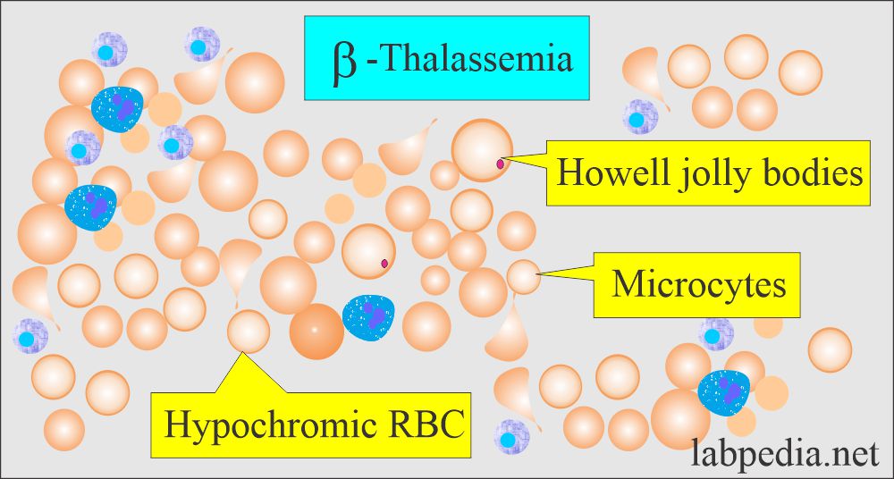Beta-thalassemia smear