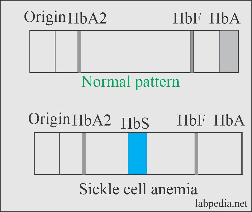 Hemoglobin electrophoresis of Sickle cell