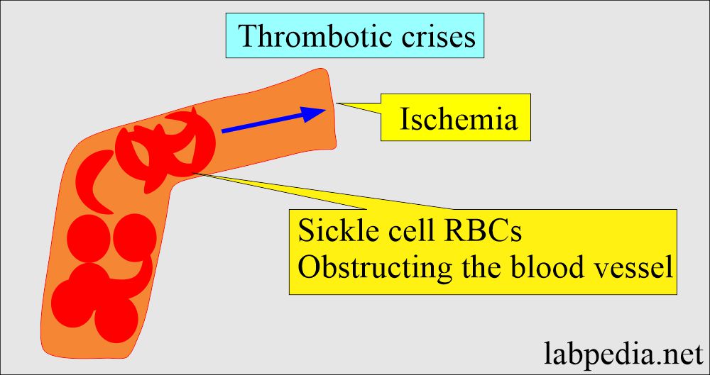 Thrombotic crises mechanism