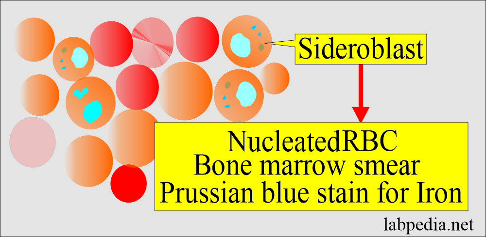 Sideroblast in the bone marrow 