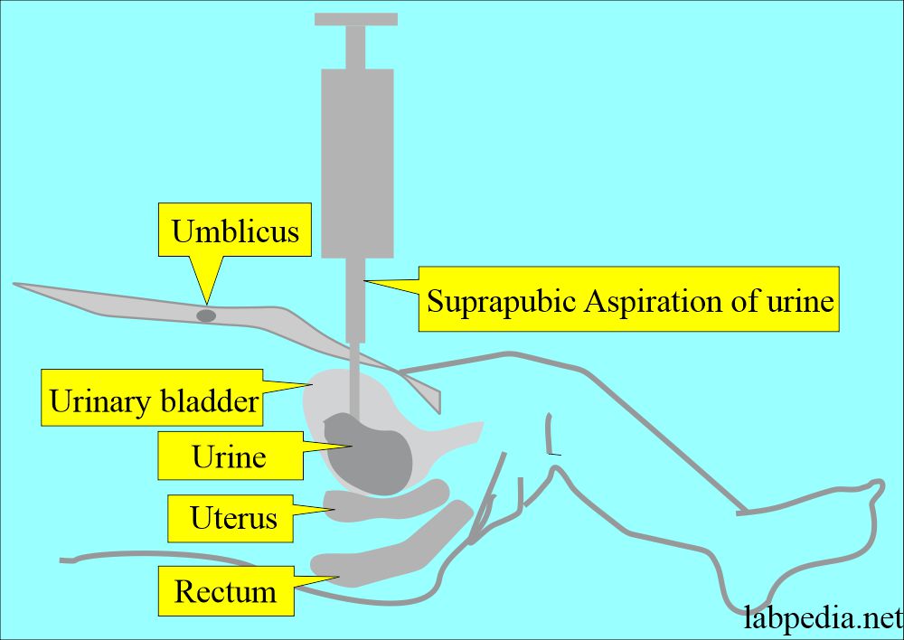 Urine samples: Urine suprapubic aspiration