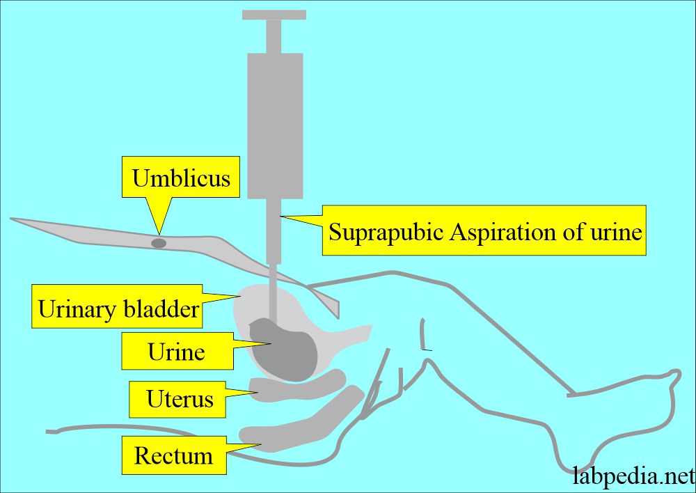 How To Get Urine Culture From Suprapubic Catheter At Catrina Franzen Blog