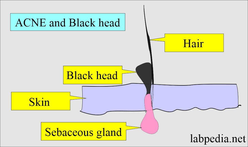 ACNE and black head