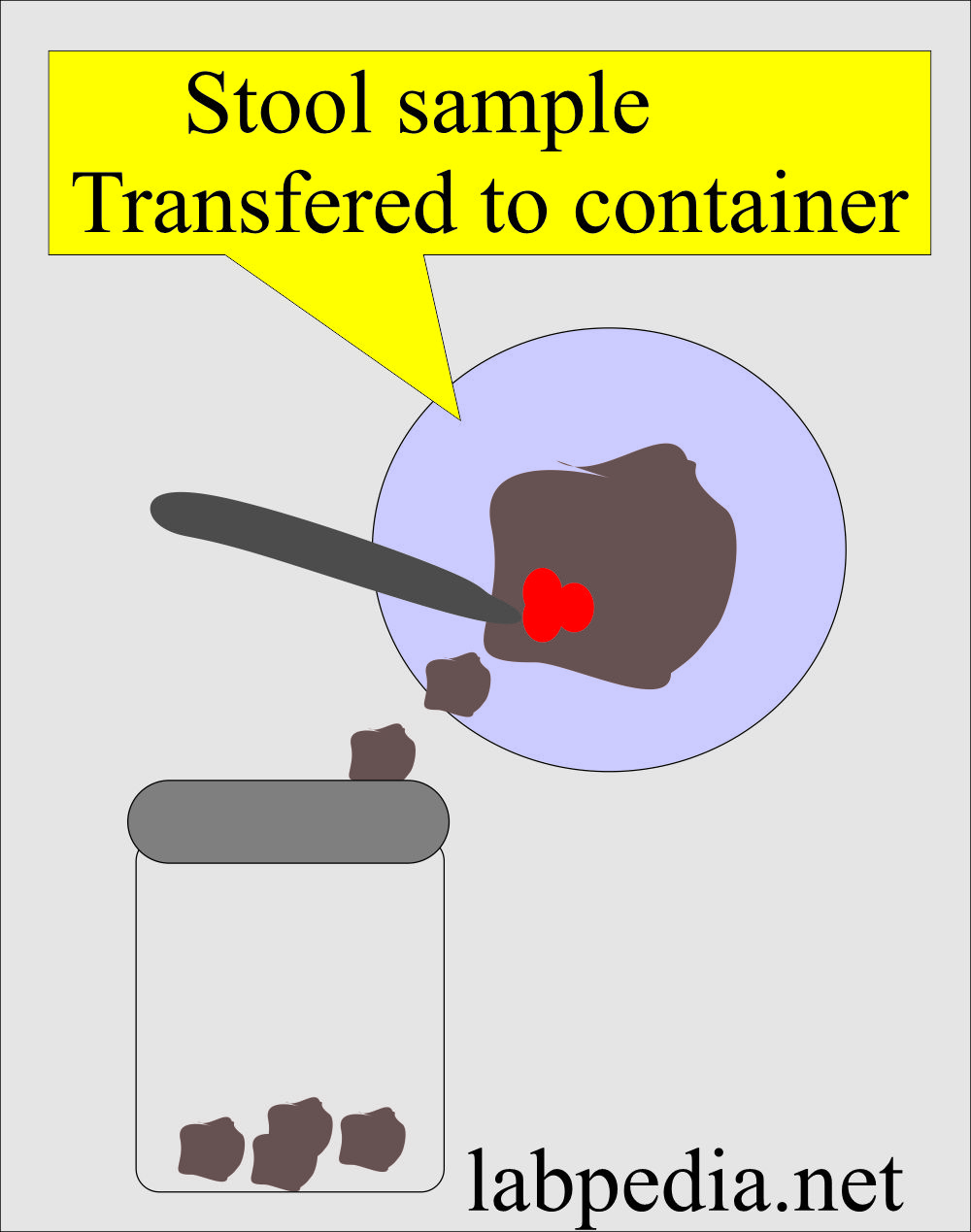 Stool sample transfer to the container